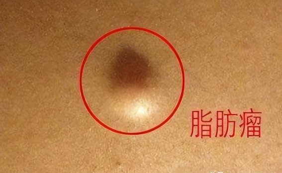 脂肪瘤的形成及应对：四个原因揭秘