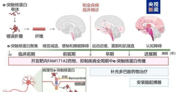 全球首次发现帕金森病新治疗靶点，中国团队成果引领突破