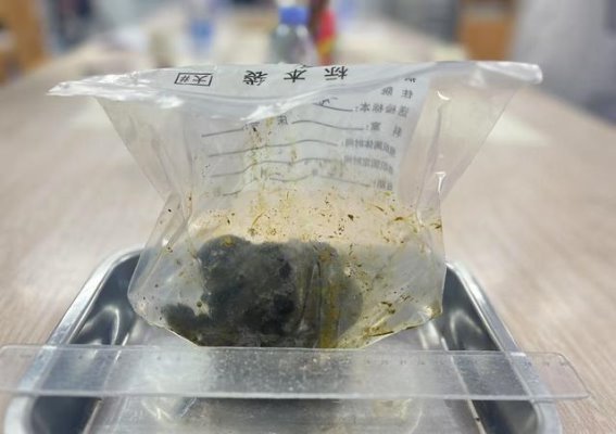 湘医再创纪录：386克巨型结石如何成功取出