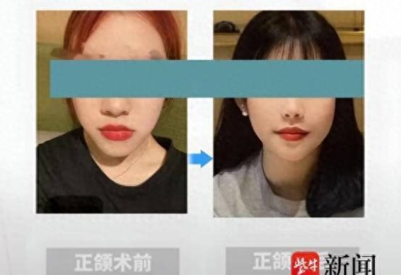 嘴凸、地包天、龅牙及大小脸的治疗方法：正颌与正畸的联合治疗方案解析