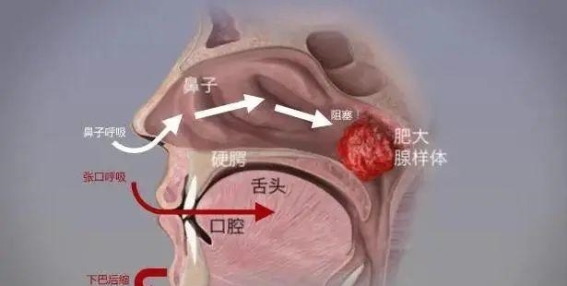 孩子长得像哪吒？这可能是病！
