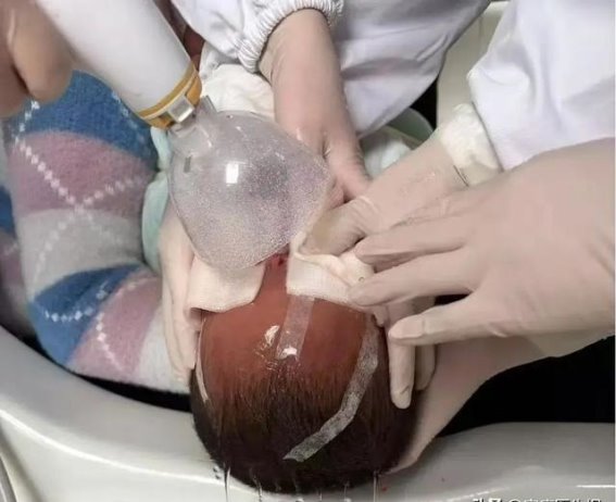 1岁男童遭家犬袭击致面部重伤 江西省儿童医院多学科联合修复容貌
