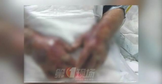 海鲜处理需谨慎，创伤弧菌感染风险高