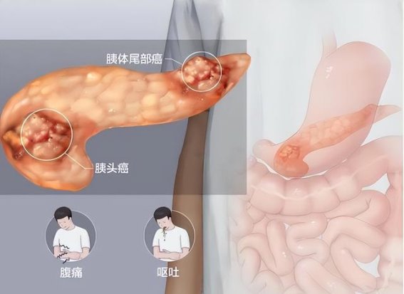 腹泻竟然成了胰腺癌的警钟？当这些症状出现时你该警觉了