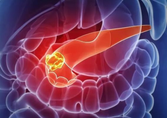 胰腺癌早期信号不是腰痛，身体6大异常需警惕